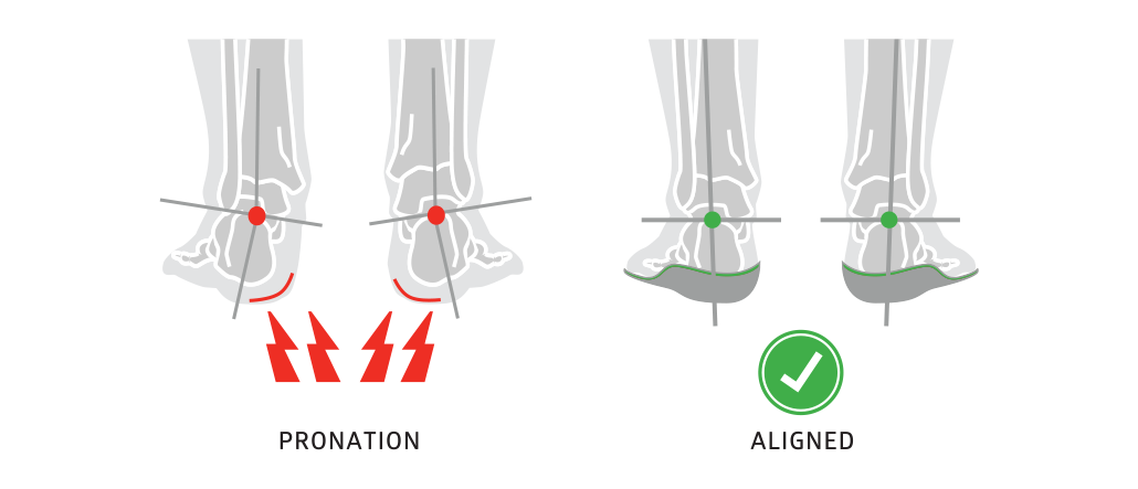 insoles for overpronation promote good alignment