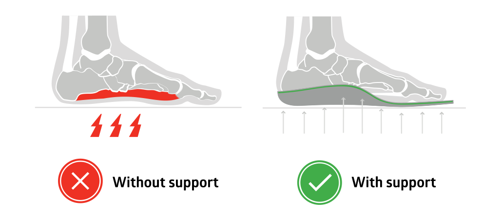 Arch Support Flat Feet Insoles - Orthotic Shoe Inserts, 3cm, Red, Unisex