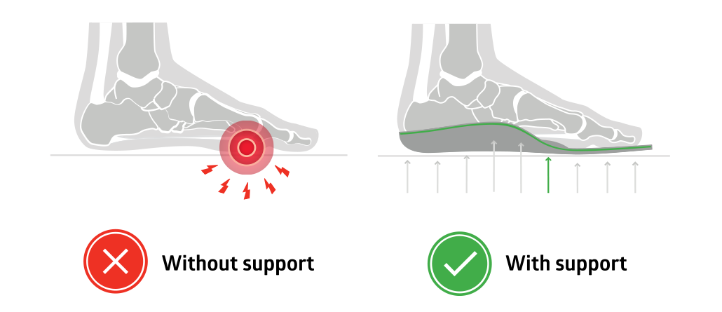 Cure Metatarsalgia with Orthopedic Insoles with a Metatarsal Pad