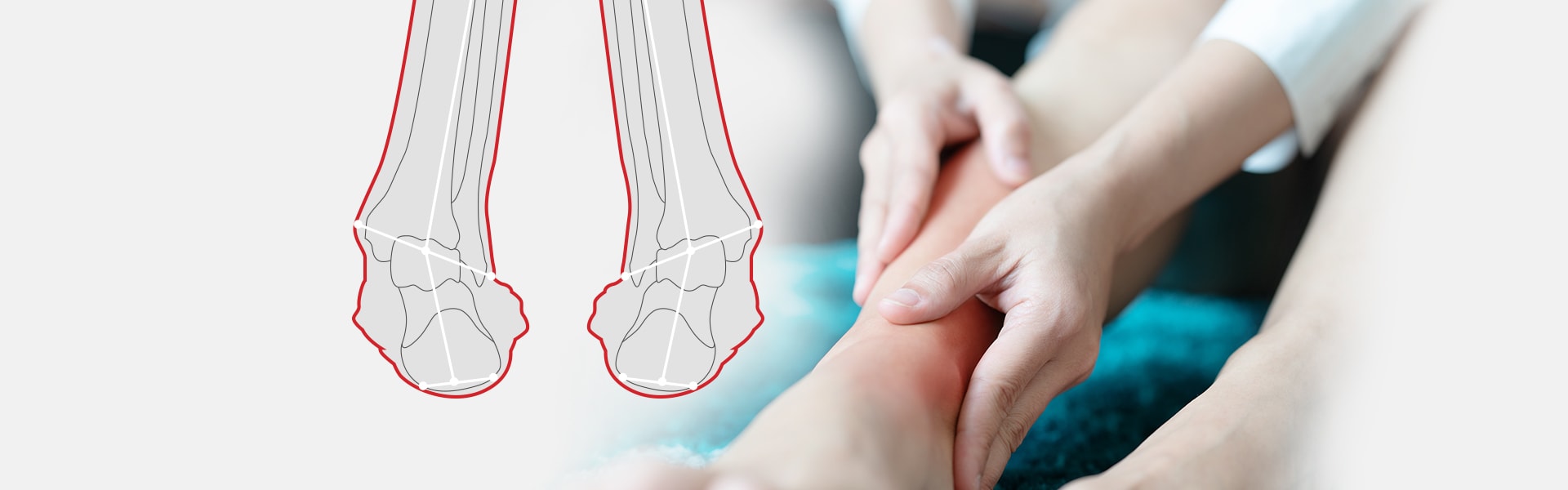 Supination of Foot and Oversupination