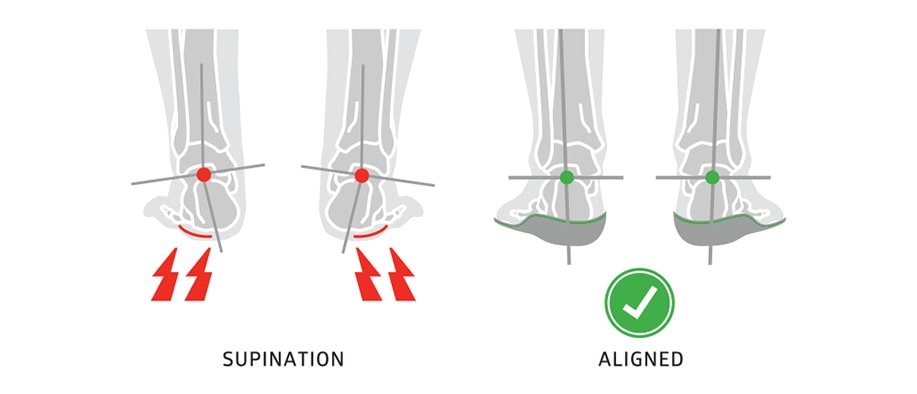 correct foot supination by promoting neutral alignment with insoles