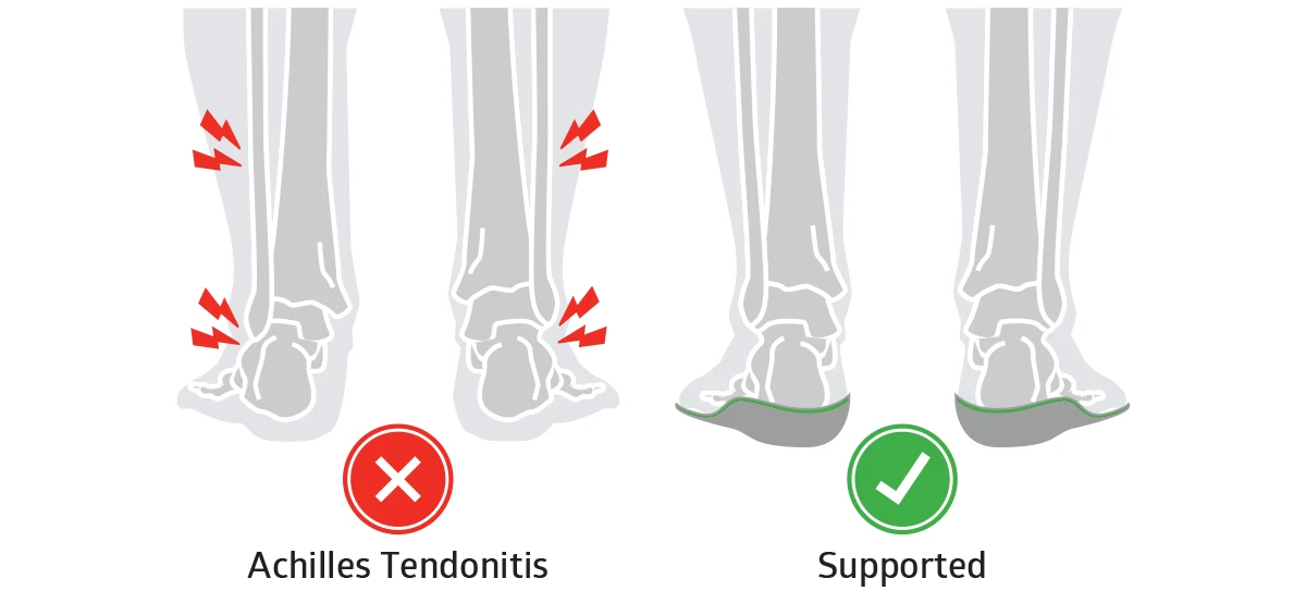 insoles for achilles tendonitis