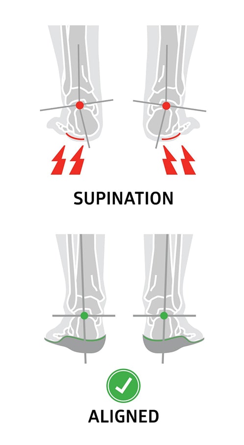 correct foot supination by promoting neutral alignment with insoles