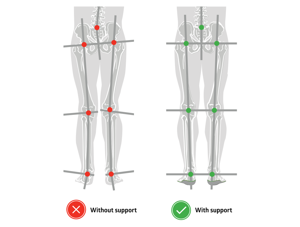 Foot, knee, hip, or back pain? Customized arch support can help