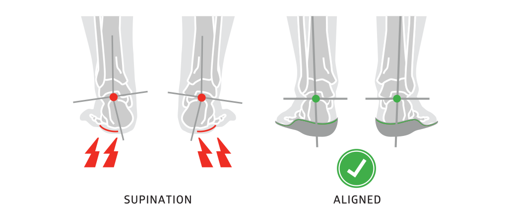 Orthopedic Insoles for Supination the Problem and the SOLE Solution SOLE