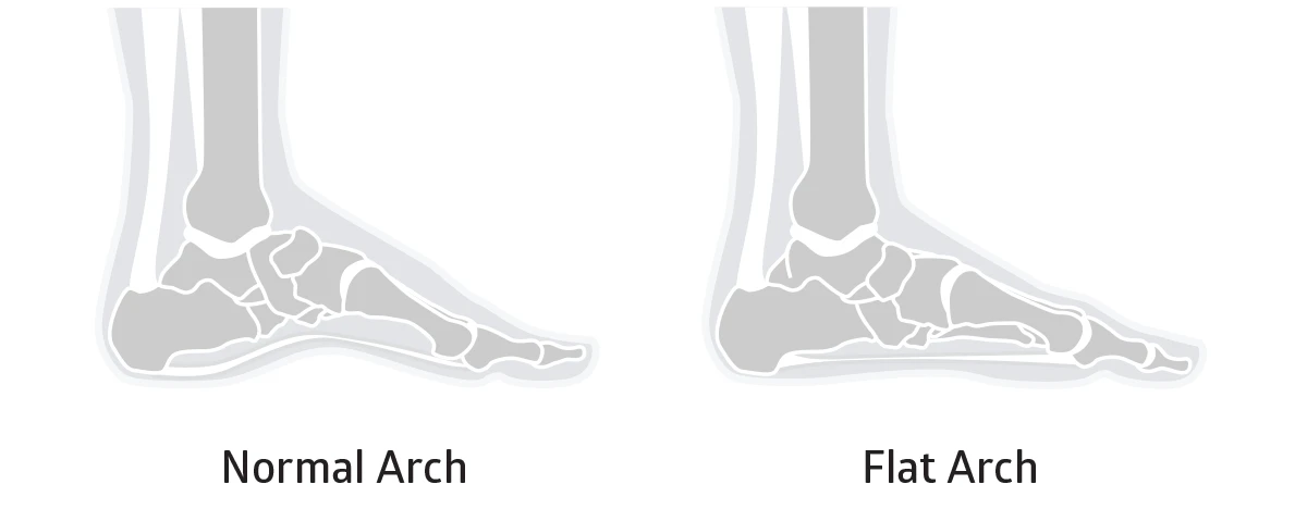 diagram of the difference between flat feet and a normal arch height