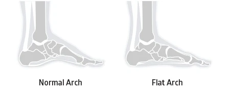 diagram of the difference between flat feet and a normal arch height