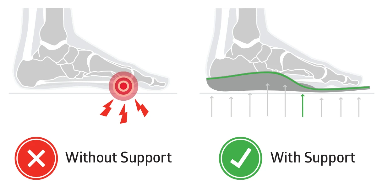 insoles with built-in metatarsal pads for metatarsalgia