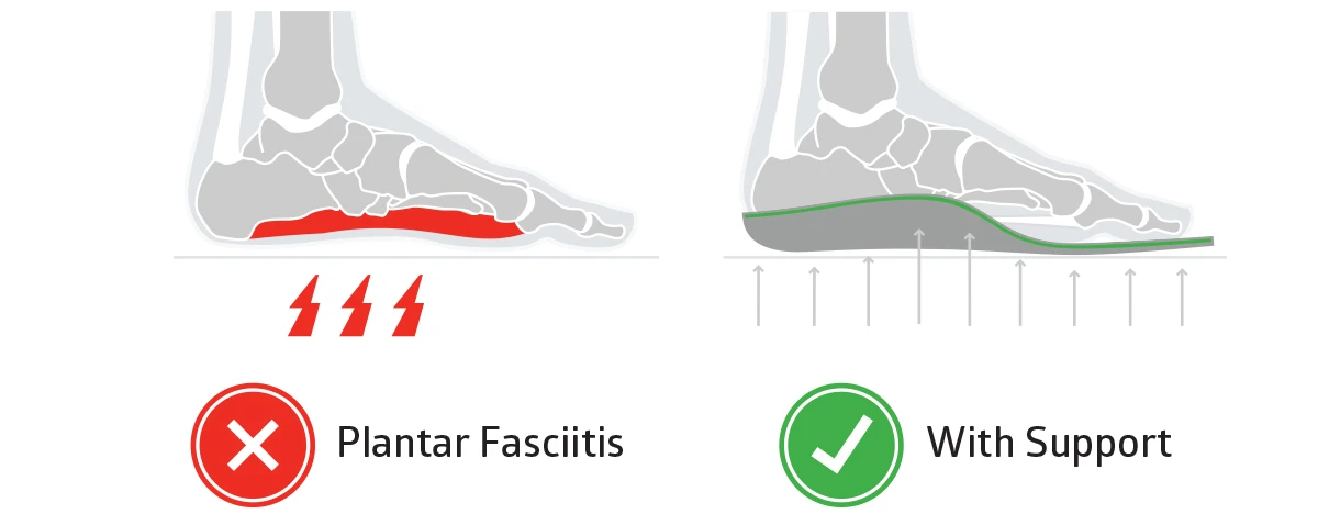 the best insoles for plantar fasciitis