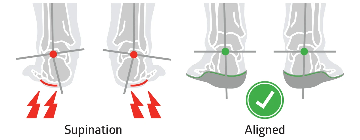 supination is walking on the outside of the foot
