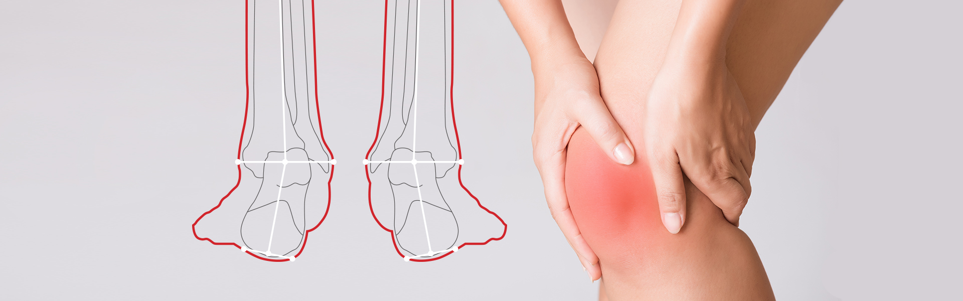 Orthopedic Insoles for Pronation: the 